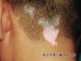 怎样预防白癜风发生扩散