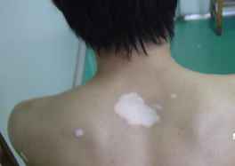 合肥白癜风哪个医院治疗好一些