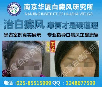 面部白癜风治疗要注意什么